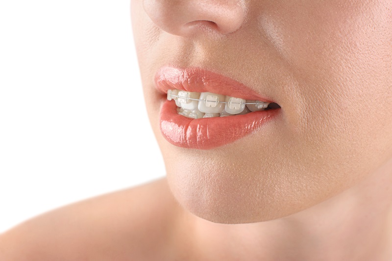 Clear Braces 
